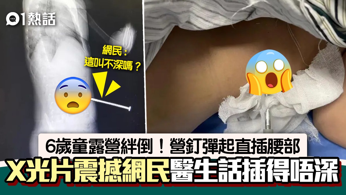 恐怖！6歲童營地奔跑遭繩絆倒　營釘直插腰X光照極震撼　專家咁講