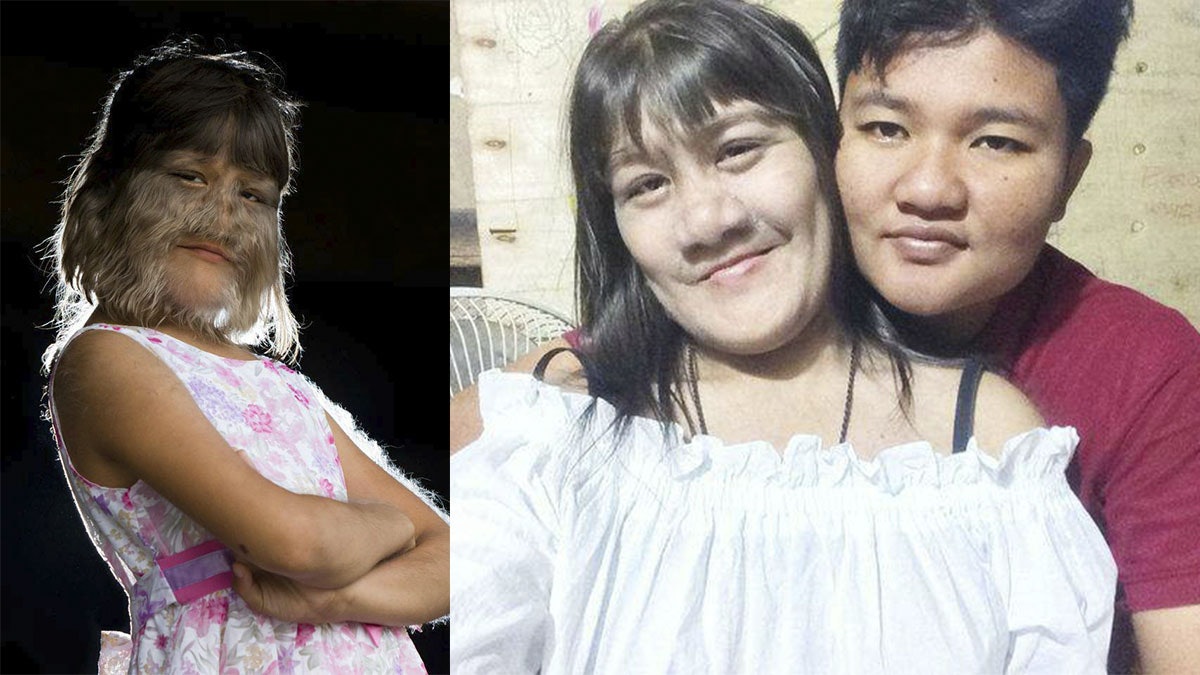 「世上最多毛女孩」17歲素素樊結婚 剃毛露清秀真貌fb放閃 「世上最多毛女孩」17歲素素樊結婚 剃毛露清秀真貌fb放閃