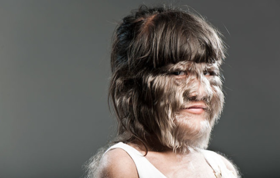 素素樊獲健力士世界紀錄認證為「世上最多毛女孩」，她患極罕見的「狼人症候群」遺傳疾病，身上及臉長都滿毛。（健力士世界紀錄網站圖片）