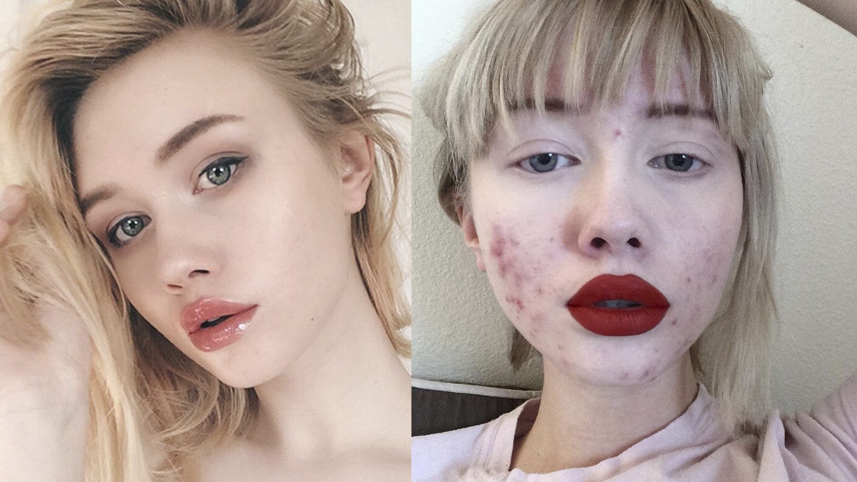 剝殼雞蛋是月球表面17歲ig女神揭暗瘡臉有人罵騙子有人讚勇敢 香港01 熱爆話題