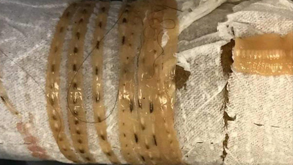 手拉寄生蟲!美國男日日食三文魚刺身 上廁所拉出1.6米日本絛蟲 手拉寄生蟲!美國男日日食三文魚刺身 上廁所拉出1.6米日本絛蟲