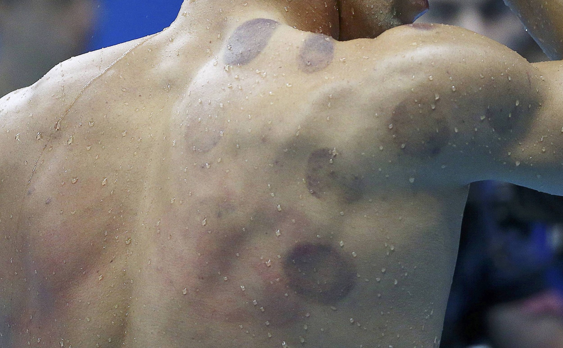 上屆奧運時，泳手菲比斯背後的拔罐印引起不少討論，而且菲比斯本人非常受落，認為甚為有效。（視覺中國）