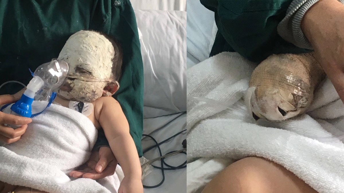 電暖爐點燃棉被着火　安徽半歲男嬰面部嚴重燒傷　4手指須截肢