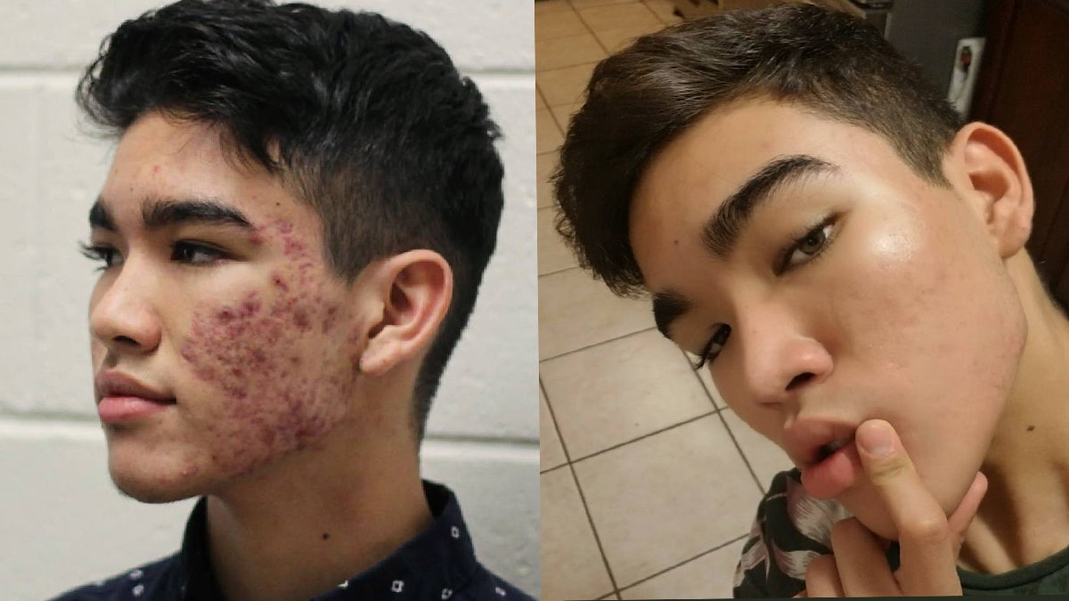 【擊退暗瘡】16歲爛面男生8個月回復白滑 護膚心得大公開 【擊退暗瘡】16歲爛面男生8個月回復白滑 護膚心得大公開