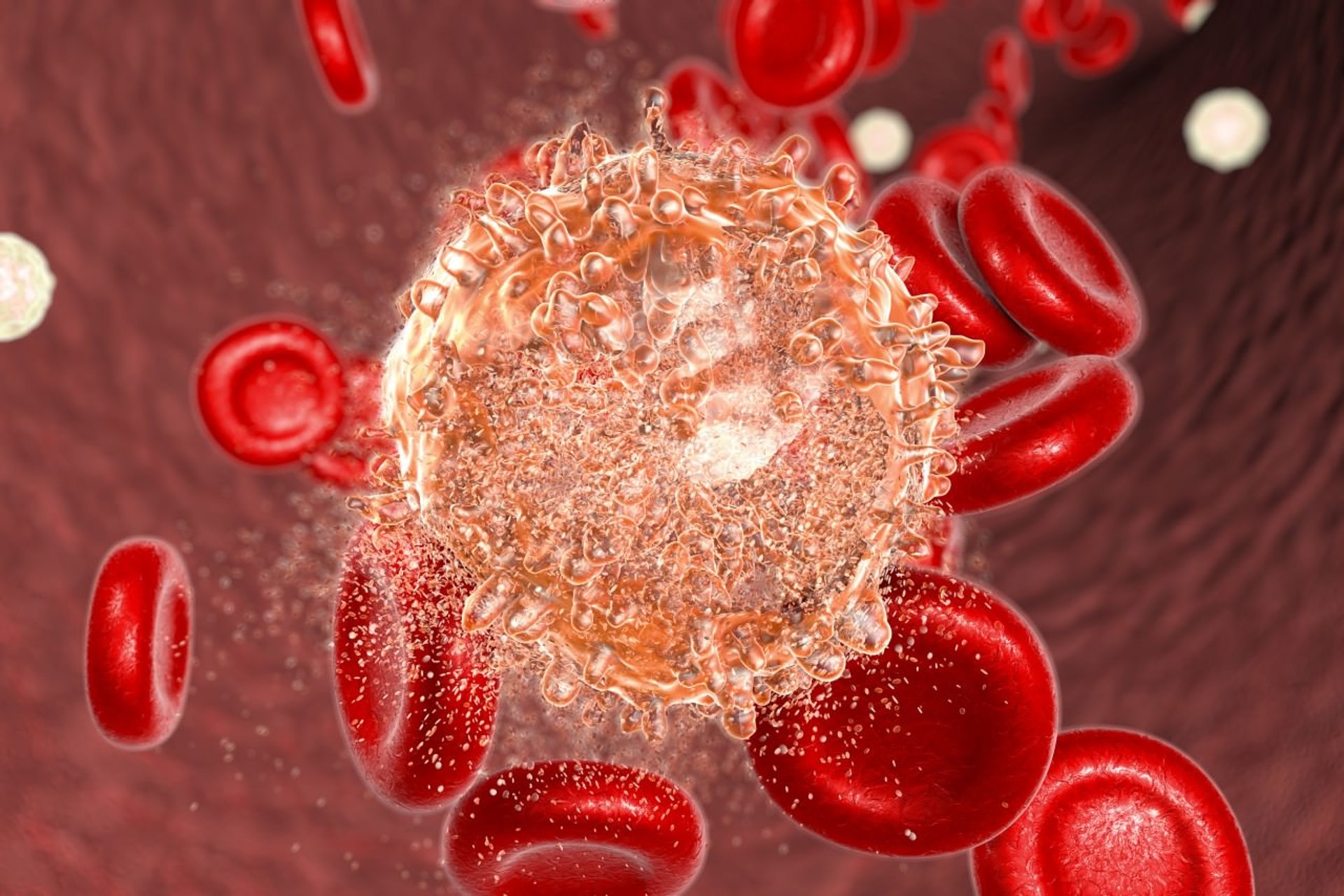 血癌是指一群負責造血的骨髓造血細胞發生變異，影響體內血液的濃度。（視覺中國）