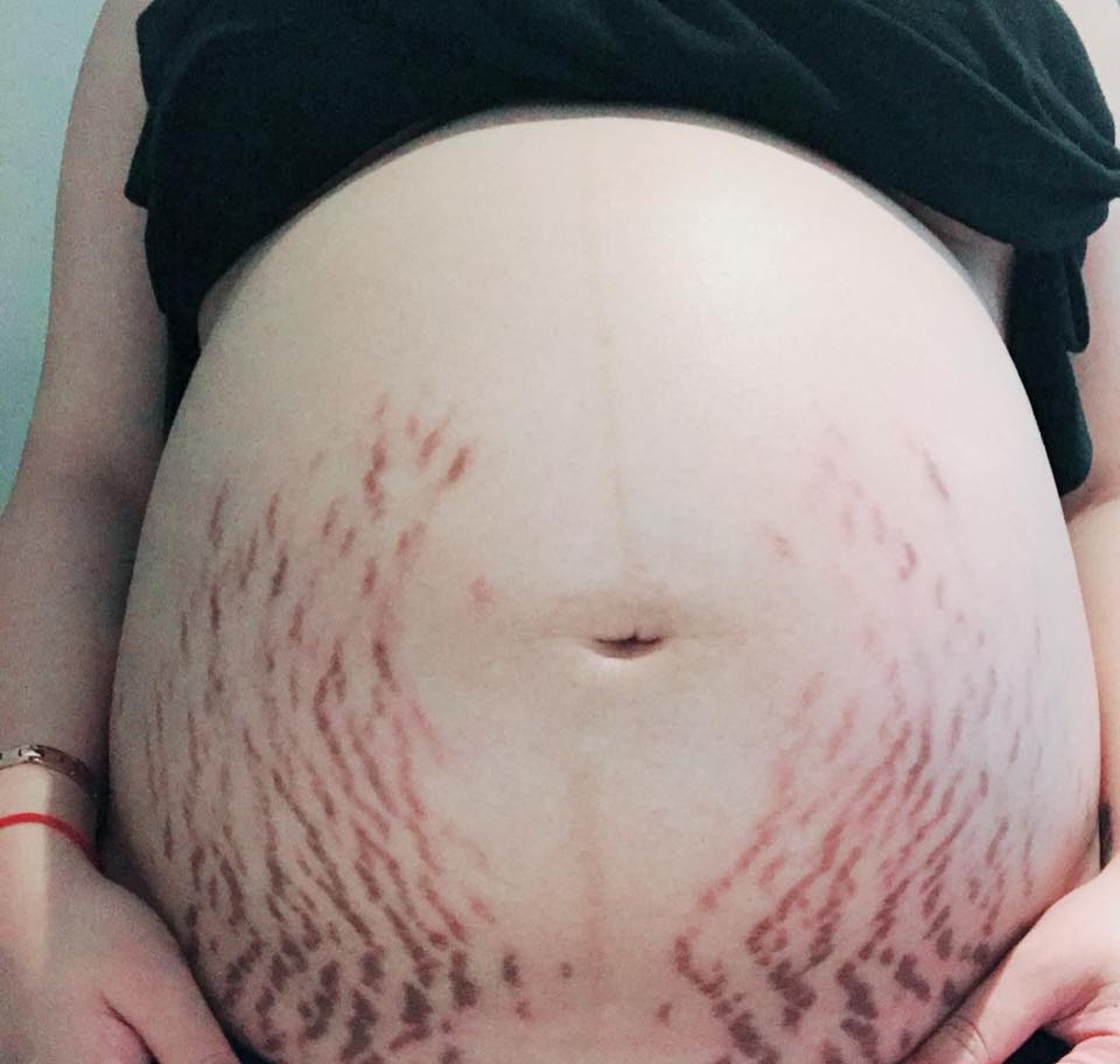 一名懷胎9個月的台灣孕婦，整個腹部長滿妊娠紋。（fb群組「爆怨公社」圖片）
