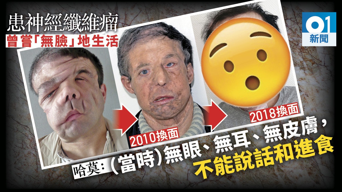 法國「三臉」男子成史上首人兩度換臉 醫生:他猶如經歷核戰 法國「三臉」男子成史上首人兩度換臉 醫生:他猶如經歷核戰