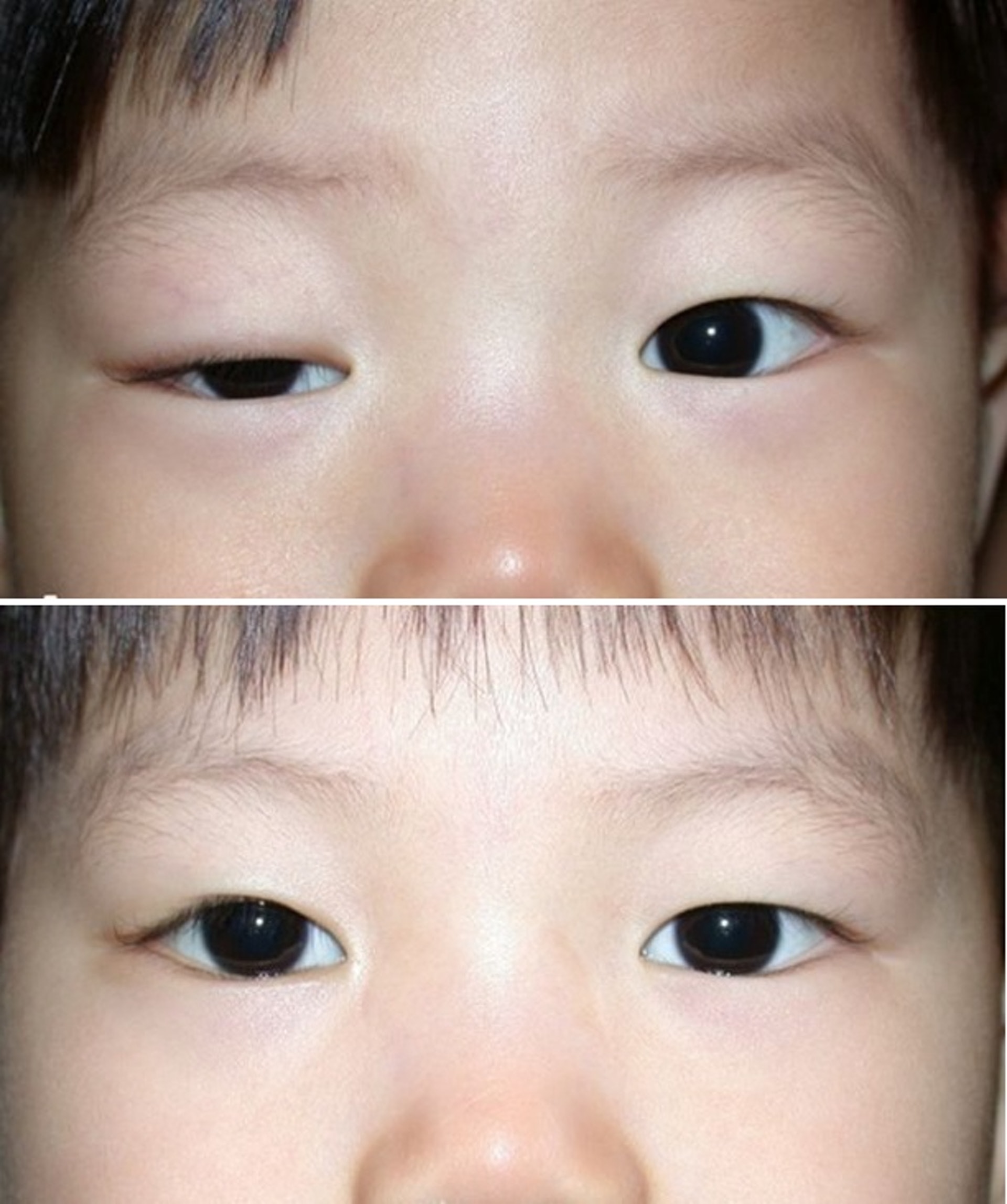 患者接受手術前(上)和手術後(下)的分別。(受訪者提供)