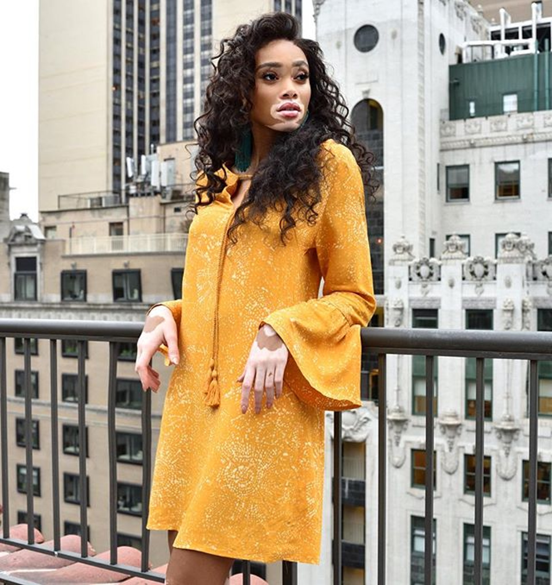 (Winnie Harlow facebook) (Winnie Harlow facebook)