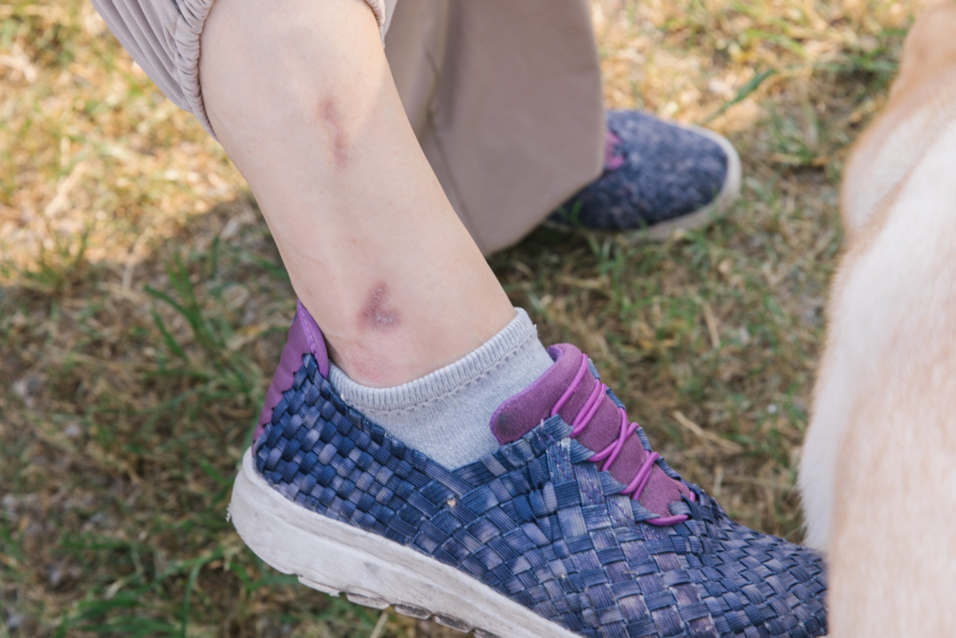 Regina曾經帶三隻狗到元朗家中附近散步,豈料其中一隻跑得太快,Regina無法拉住,就這樣失衡摔了在地,傷疤留至現在,自此之後她也不敢再帶三隻狗一同外出。