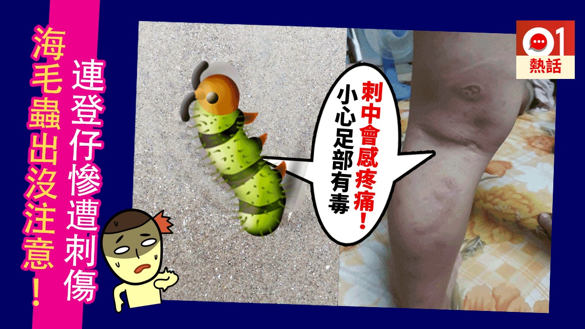【多圖有片慎入】香港沙灘驚現有毒海毛蟲 網民腳中招疼痛籲提防 【多圖有片慎入】香港沙灘驚現有毒海毛蟲 網民腳中招疼痛籲提防