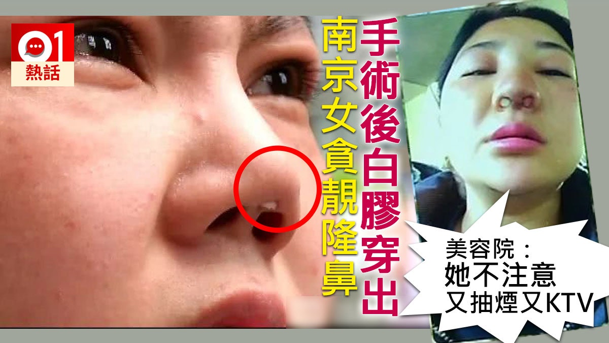 南京女花3萬人仔隆鼻失敗白膠 破鼻而出 像豬鼻子一樣 香港01 熱爆話題 南京女花3萬人仔隆鼻失敗白膠 破鼻而出 像豬鼻子一樣 香港01 熱爆話題