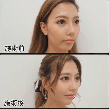 日本整容雙胞胎模特兒沉迷變臉竟成為少女指標 香港01 即時娛樂