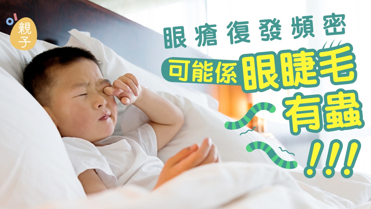 兒童眼瘡 經常復發有原因 醫生教如何熱敷加快痊癒 香港01 親子 兒童眼瘡 經常復發有原因 醫生教如何熱敷加快痊癒 香港01 親子