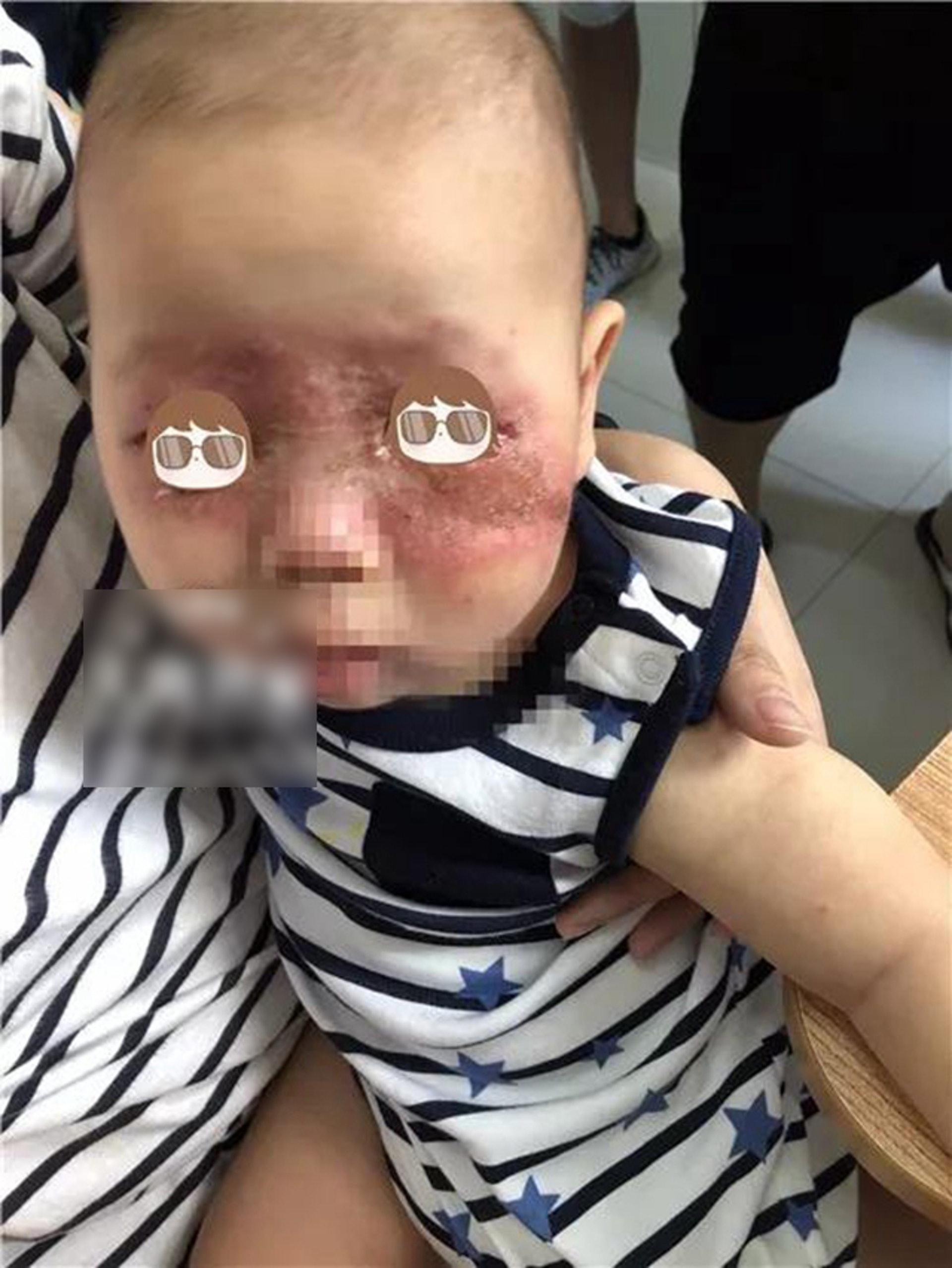 內地童面部皮膚灼傷,近乎毀容。(微博圖片) 內地童面部皮膚灼傷,近乎毀容。(微博圖片)