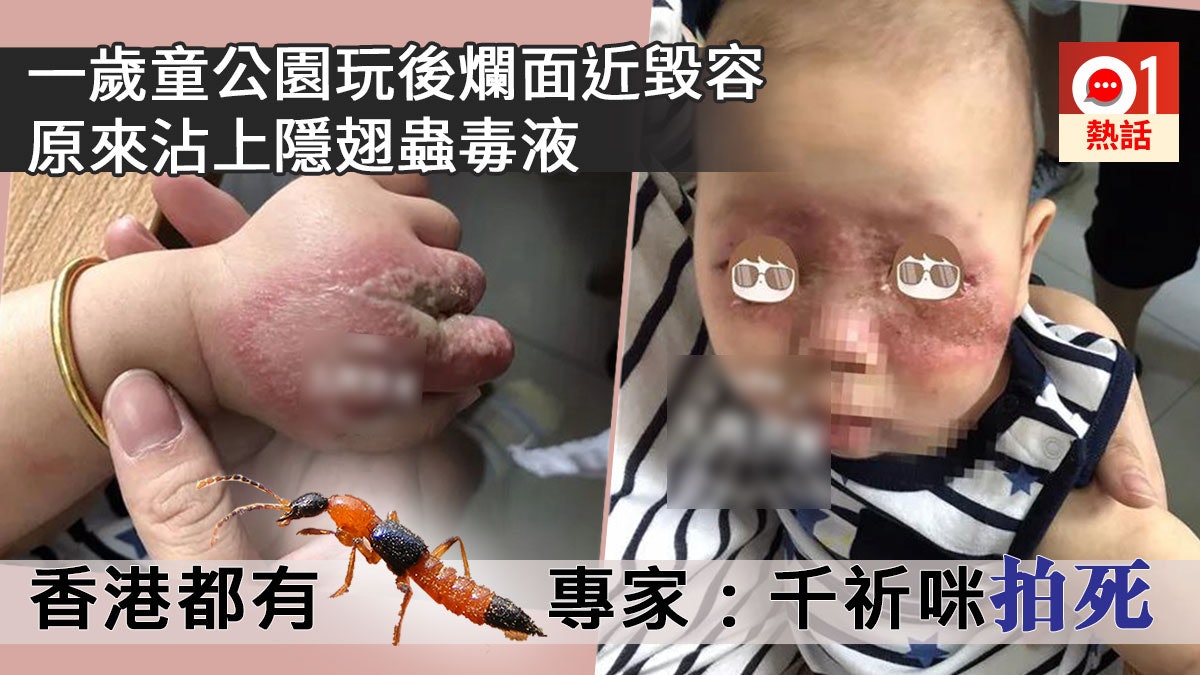 浙江童公園玩沾隱翅蟲毒液毀容 港郊區也有 專家:千祈咪拍死佢 浙江童公園玩沾隱翅蟲毒液毀容 港郊區也有 專家:千祈咪拍死佢