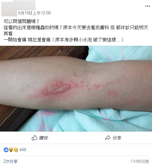台灣近日有女生不慎沾染到隱翅蟲毒液而受傷，手臂皮膚出現紅腫潰爛。（fb群組「爆廢公社公開版」截圖）