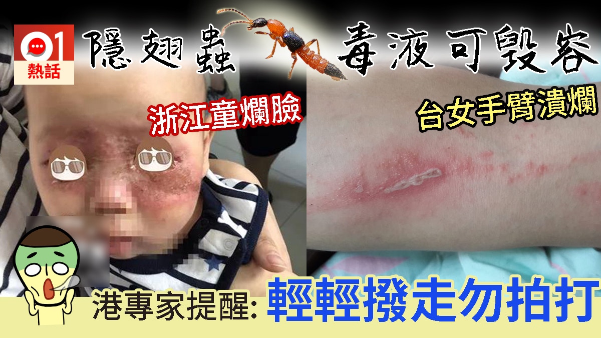 隱翅蟲毒液可毀容　台女沾染皮膚潰爛　專家：香港也有　不要拍打