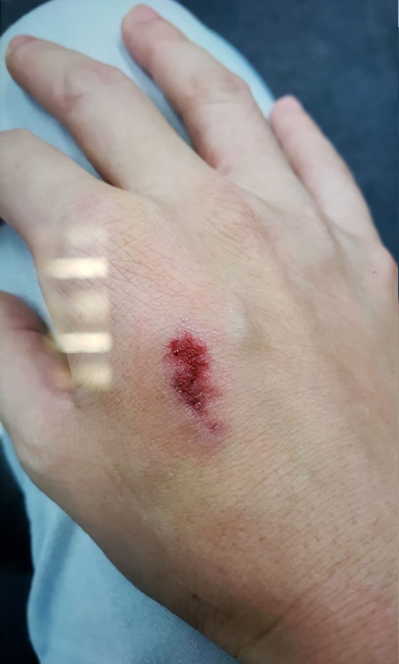 入境處女職員右手背遭唐琳玲咬至出血,她到醫院治療並報警。 入境處女職員右手背遭唐琳玲咬至出血,她到醫院治療並報警。