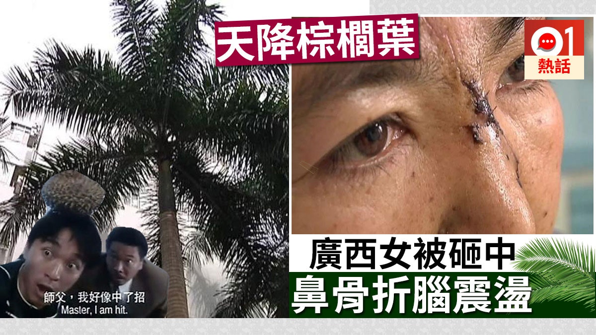 出門小心 散步時天降棕櫚樹葉廣西女被砸至鼻樑骨折兼腦震盪 香港01 熱爆話題 出門小心 散步時天降棕櫚樹葉廣西女被砸至鼻樑骨折兼腦震盪 香港01 熱爆話題