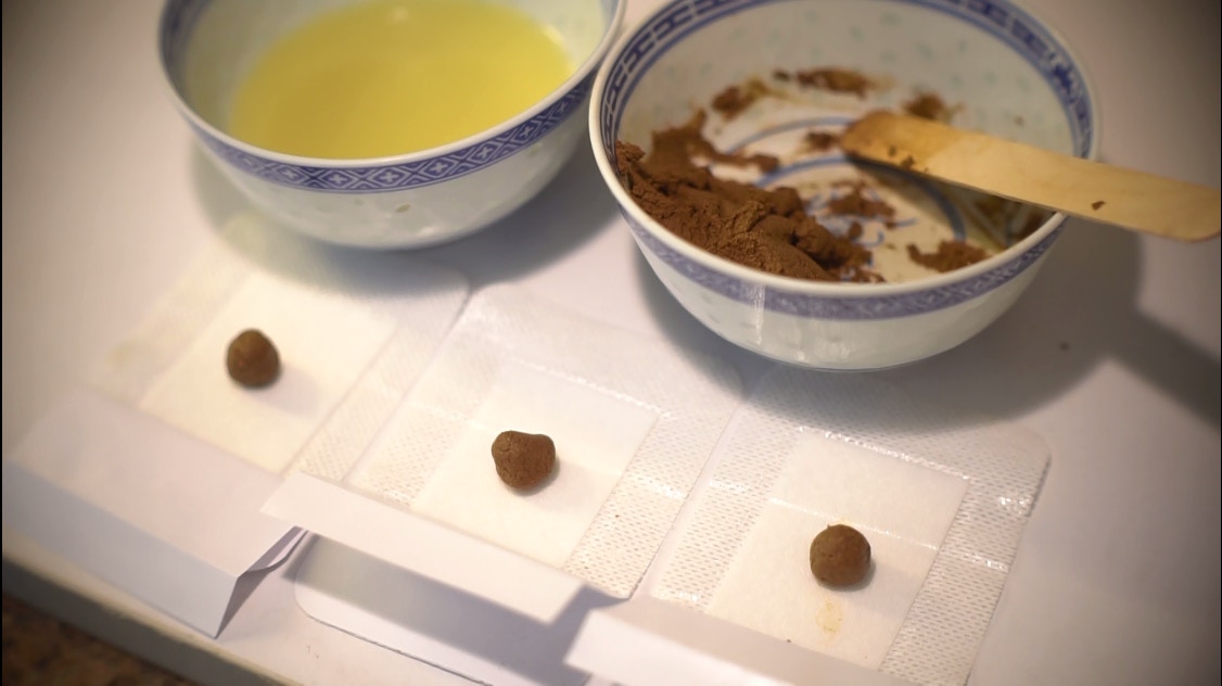 【天灸療法】研製「三伏貼」過程大公開 記者親身試