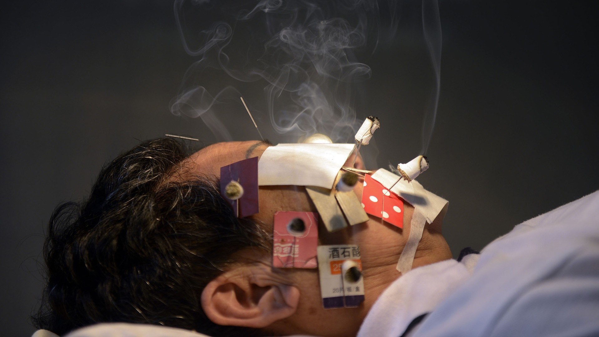 圖話 艾絨飄煙 鋼針刺臉三伏天來臨病患求醫 冬病夏治 醫師easy 圖話 艾絨飄煙 鋼針刺臉三伏天來臨病患求醫 冬病夏治 醫師easy