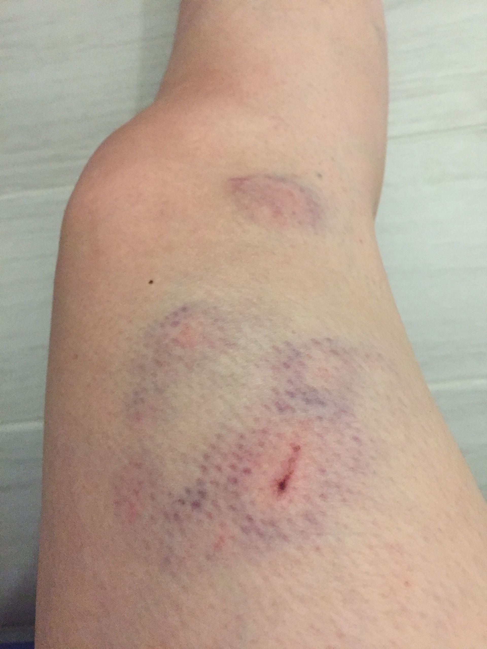 Esther的大腿被Carson咬致出現瘀痕 (受訪者提供) Esther的大腿被Carson咬致出現瘀痕 (受訪者提供)