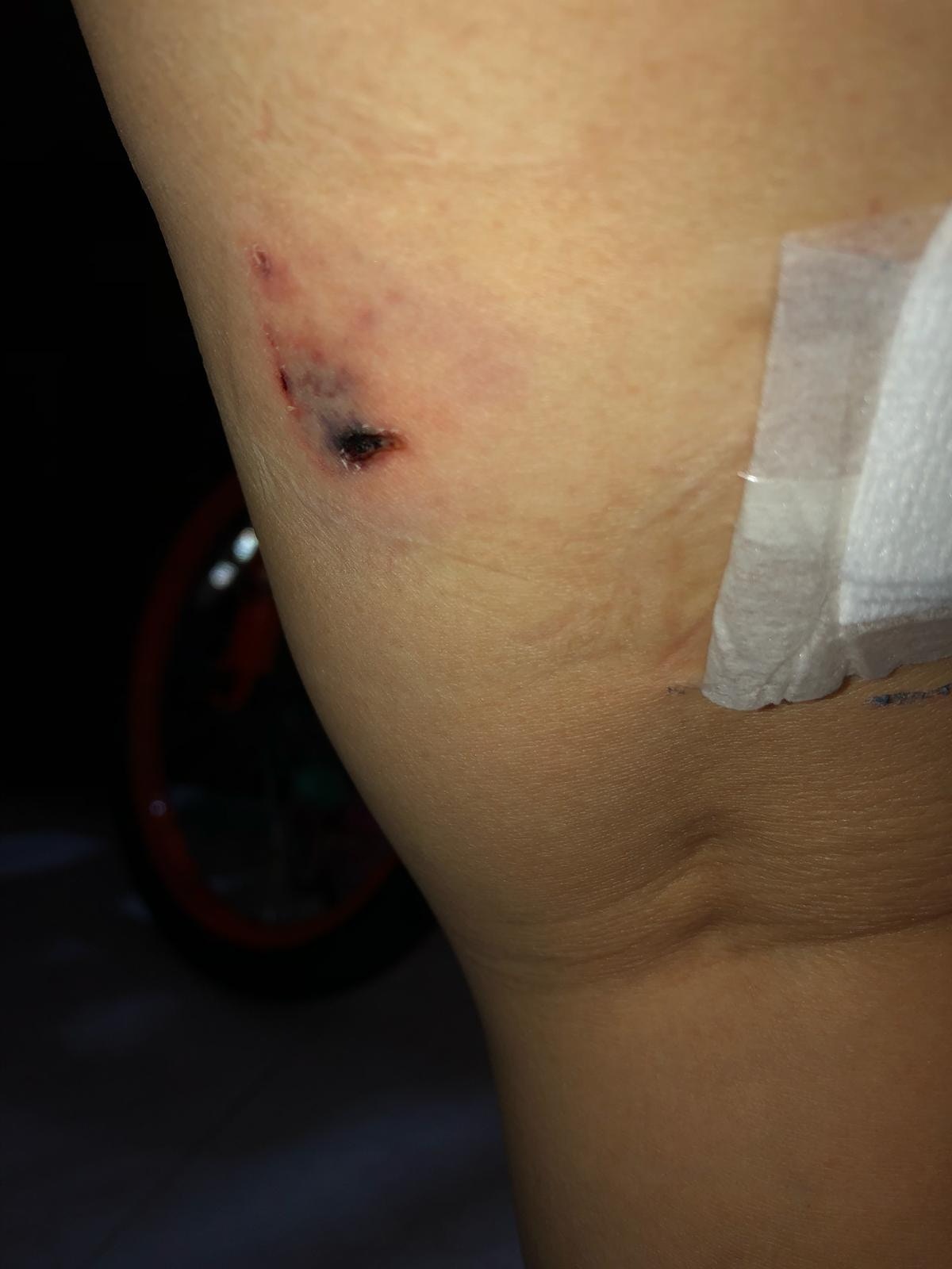 廖小姐遭流浪狗咬傷大腿外側,留下瘀黑傷口。(圖片由黃逸旭提供) 廖小姐遭流浪狗咬傷大腿外側,留下瘀黑傷口。(圖片由黃逸旭提供)