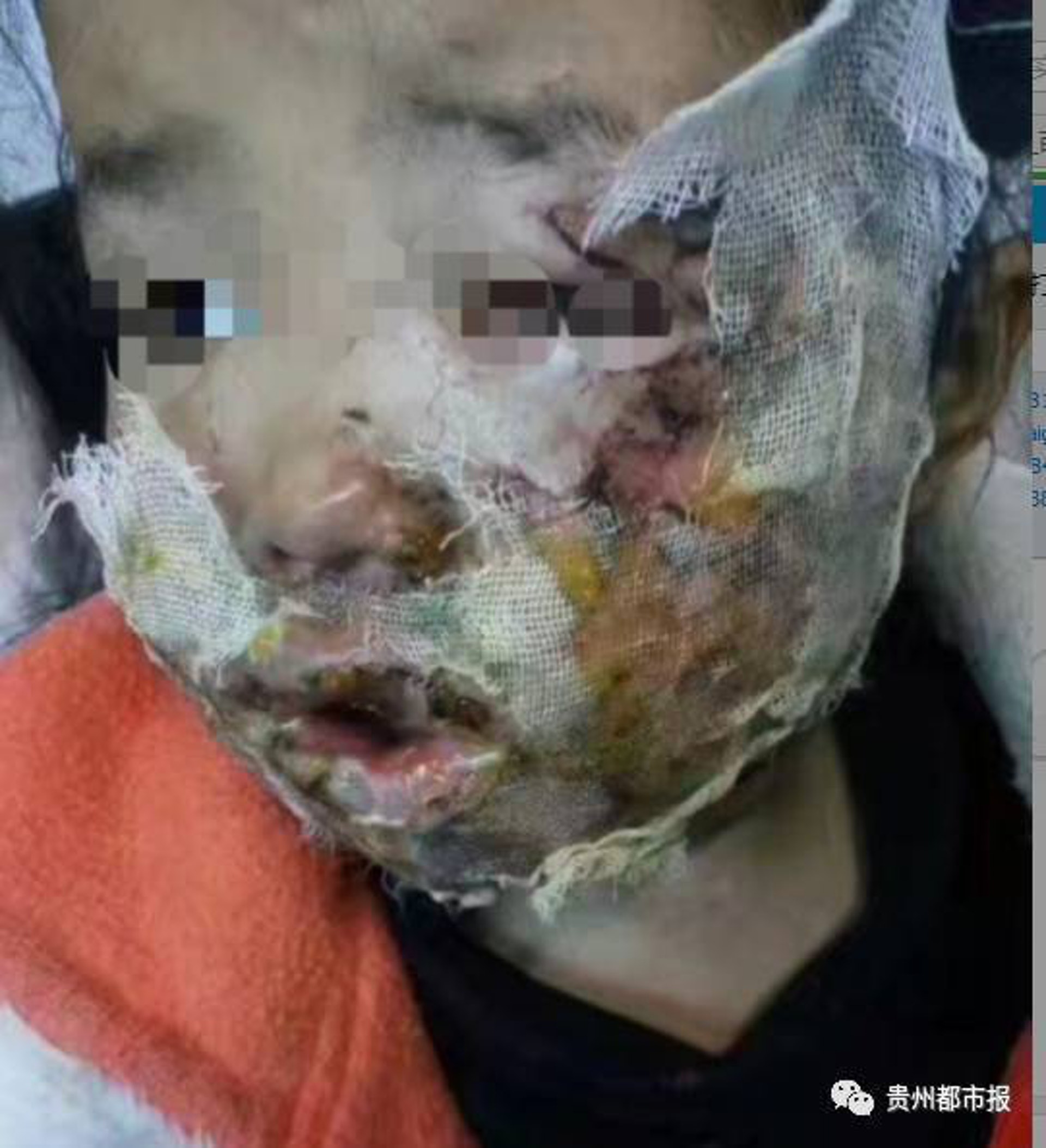 馮玲玲的女兒臉部、手部被炸傷。照片為2017年時拍攝。(貴州都市報) 馮玲玲的女兒臉部、手部被炸傷。照片為2017年時拍攝。(貴州都市報)