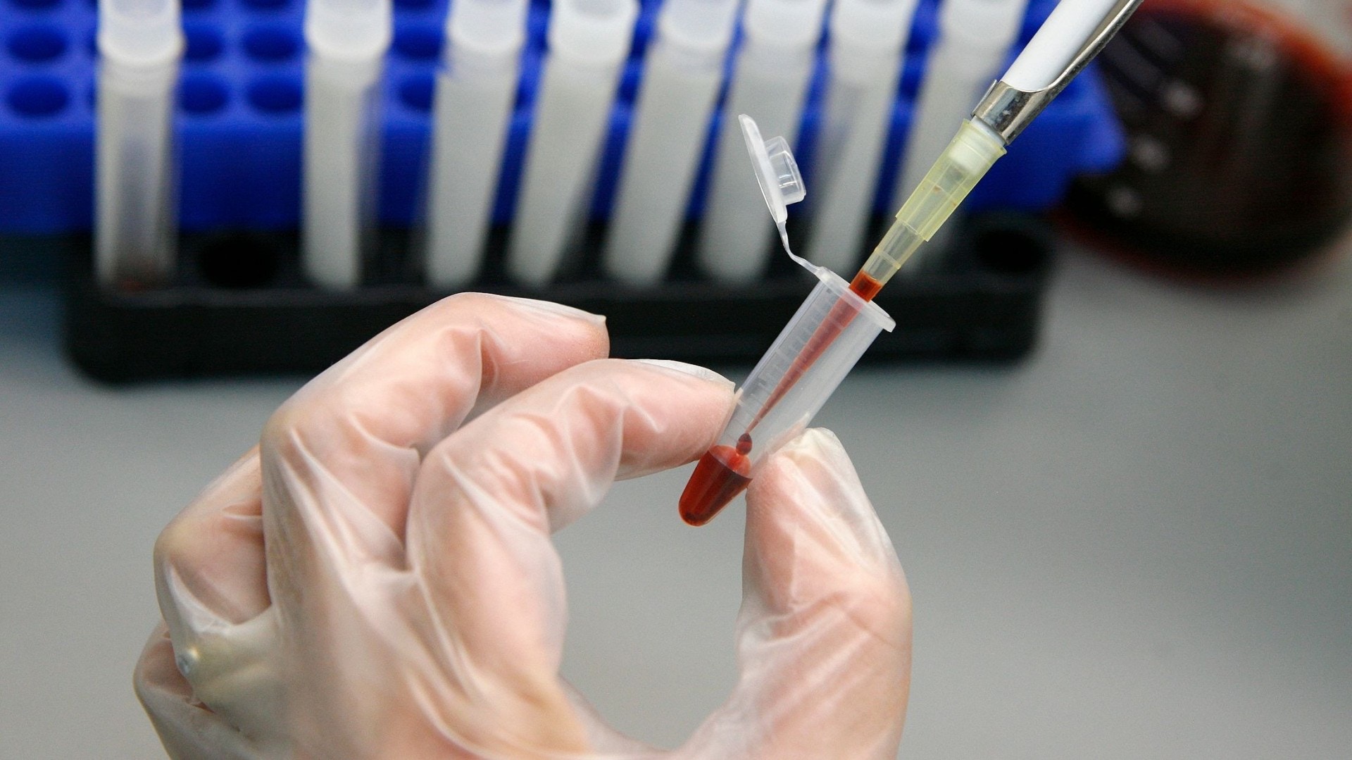 加拿大研究發現變種HIV病毒　患者一個月內或病發