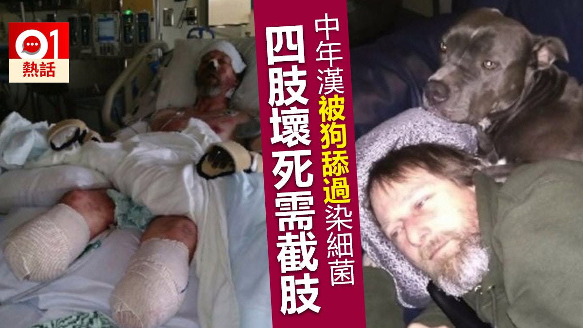 【口水有菌】被狗舔過感染敗血症美國漢需截四肢保命