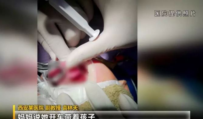 西安母親帶着子女駕車外出，遇彎時突然剎車，其中1歲兒子失去重心，下巴撞向車門手把，幾近咬斷舌頭。（微博截圖）