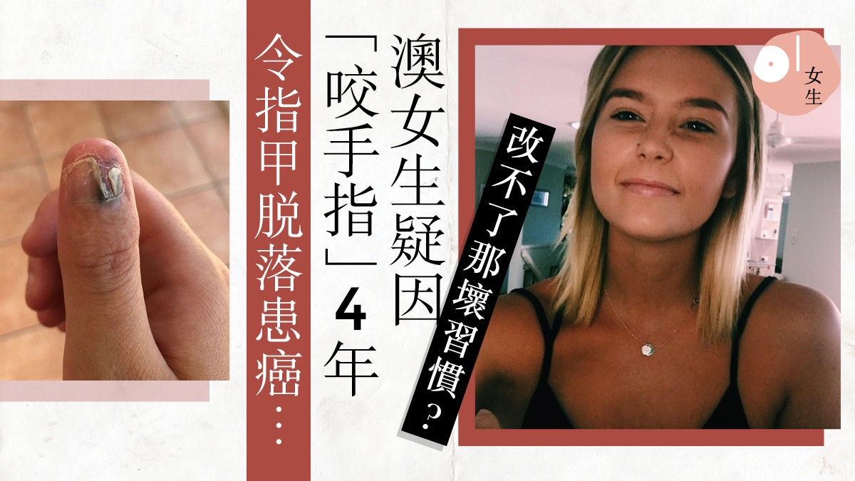 【咬手指致癌?】澳女生遭校園欺凌 疑養成咬手惡習致癌:需截指 【咬手指致癌?】澳女生遭校園欺凌 疑養成咬手惡習致癌:需截指