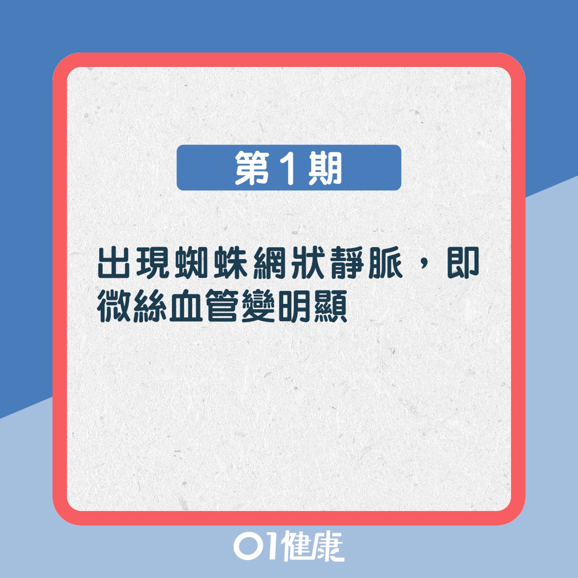 靜脈曲張知多啲!(01製圖) 靜脈曲張知多啲!(01製圖)