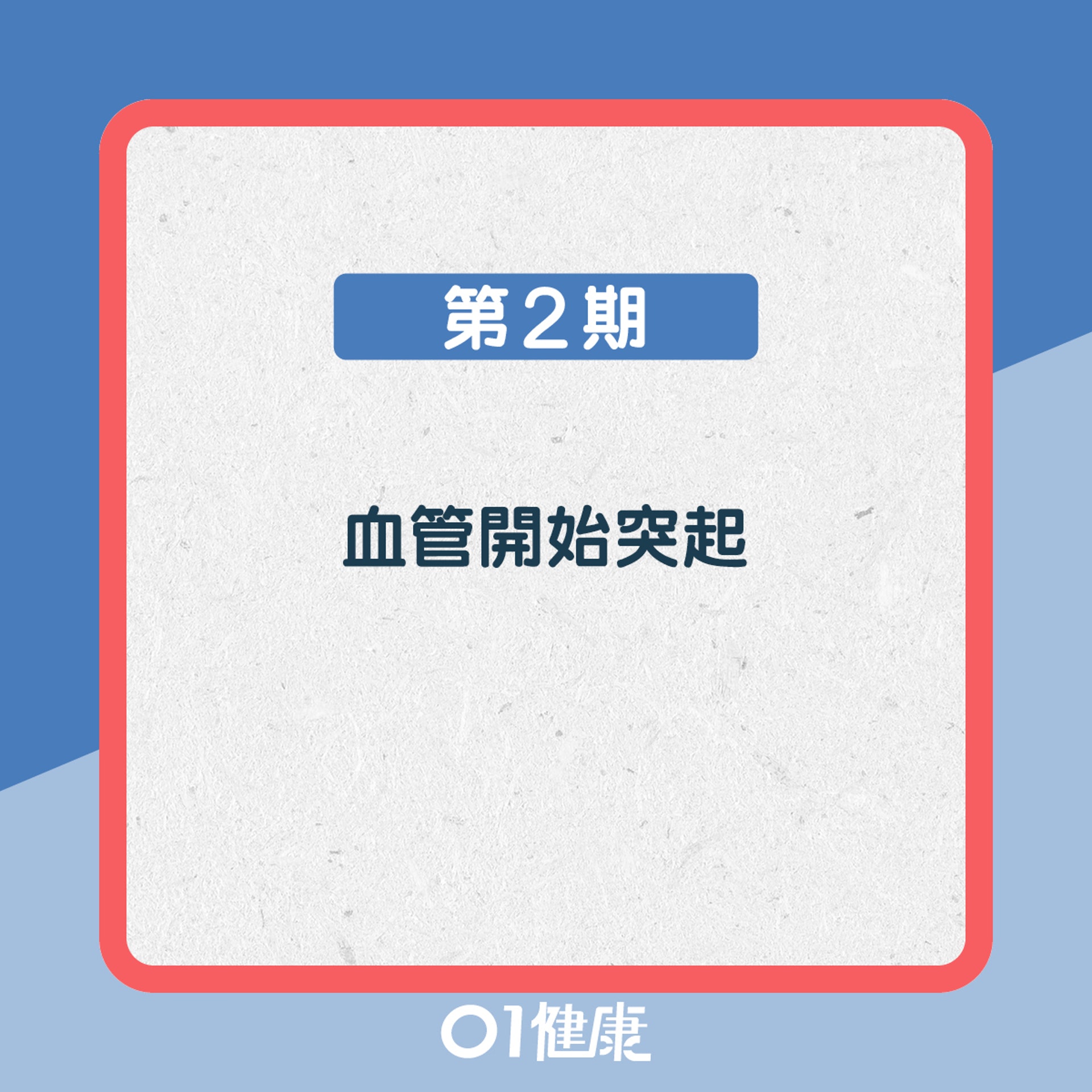 靜脈曲張知多啲!(01製圖) 靜脈曲張知多啲!(01製圖)