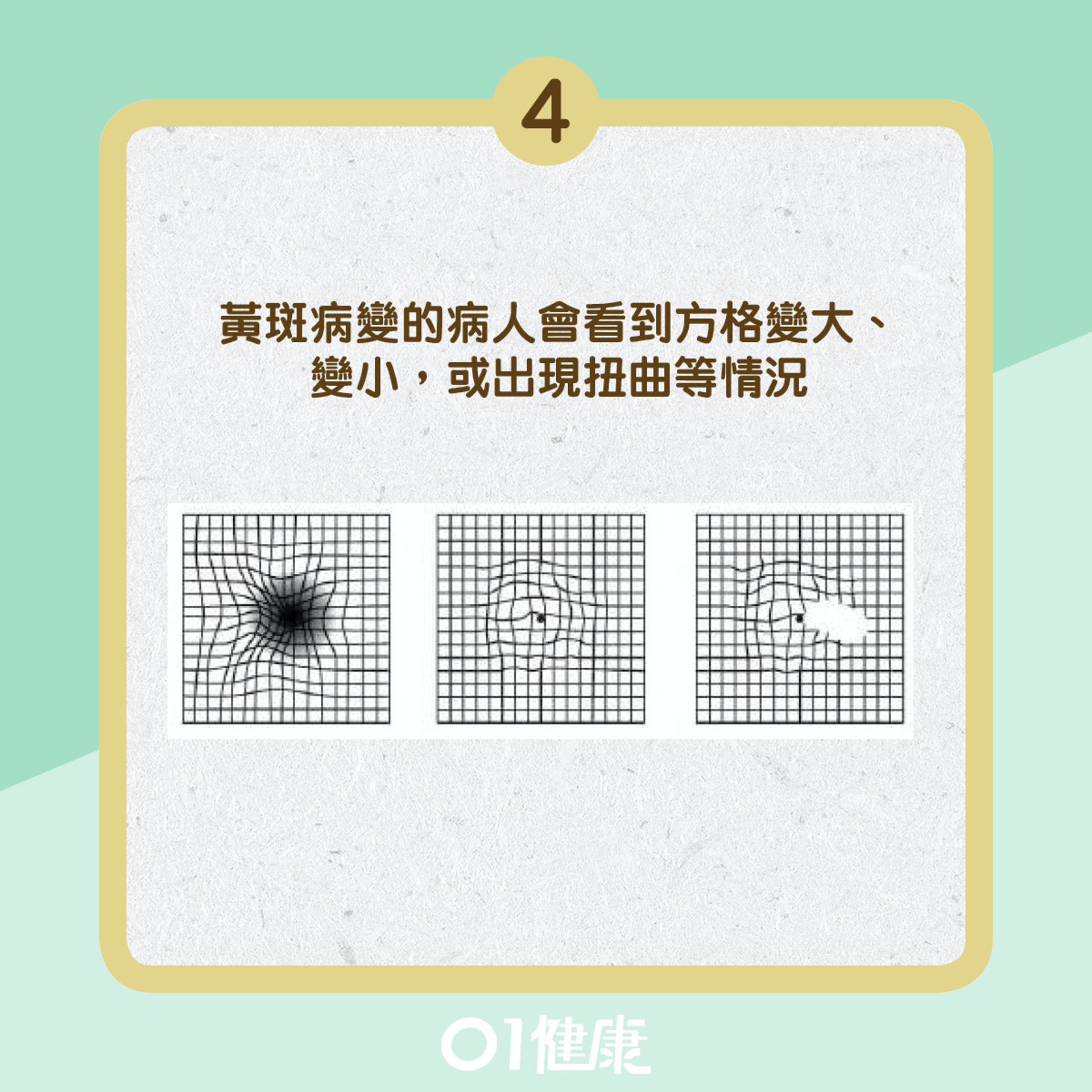 (圖片來源:台大醫院眼科部) (圖片來源:台大醫院眼科部)