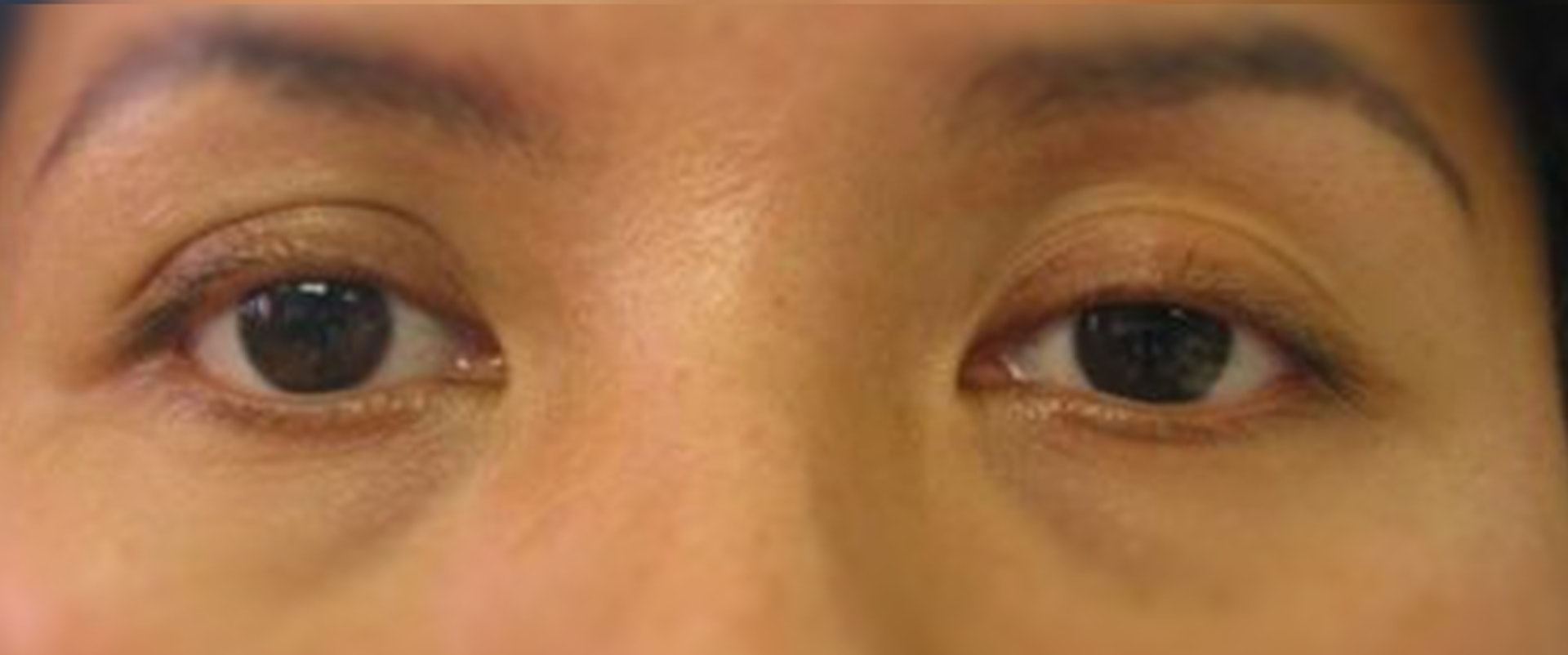 拉開眼皮戴隱形眼鏡肌肉鬆馳下垂變大細眼要做整形手術醫治 香港01 社會新聞 拉開眼皮戴隱形眼鏡肌肉鬆馳下垂變大細眼要做整形手術醫治 香港01 社會新聞