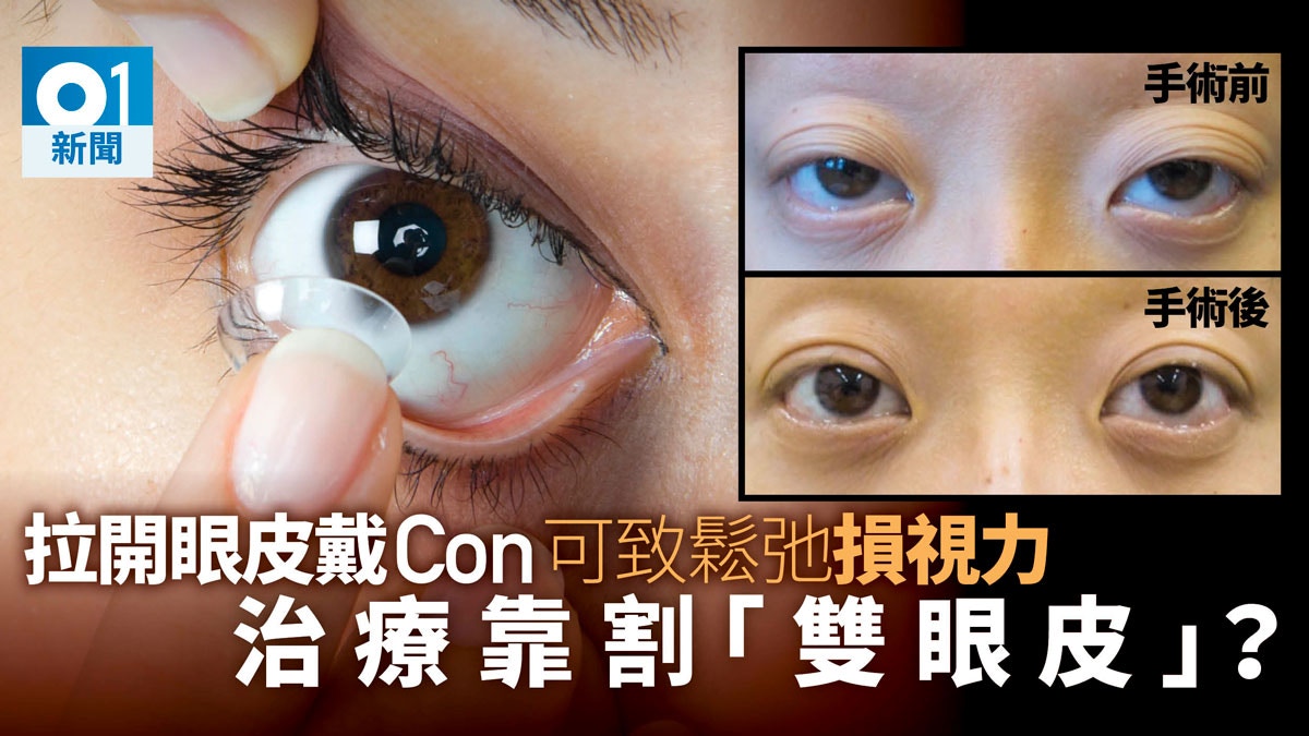 拉開眼皮戴隱形眼鏡肌肉鬆馳下垂變大細眼要做整形手術醫治 香港01 社會新聞