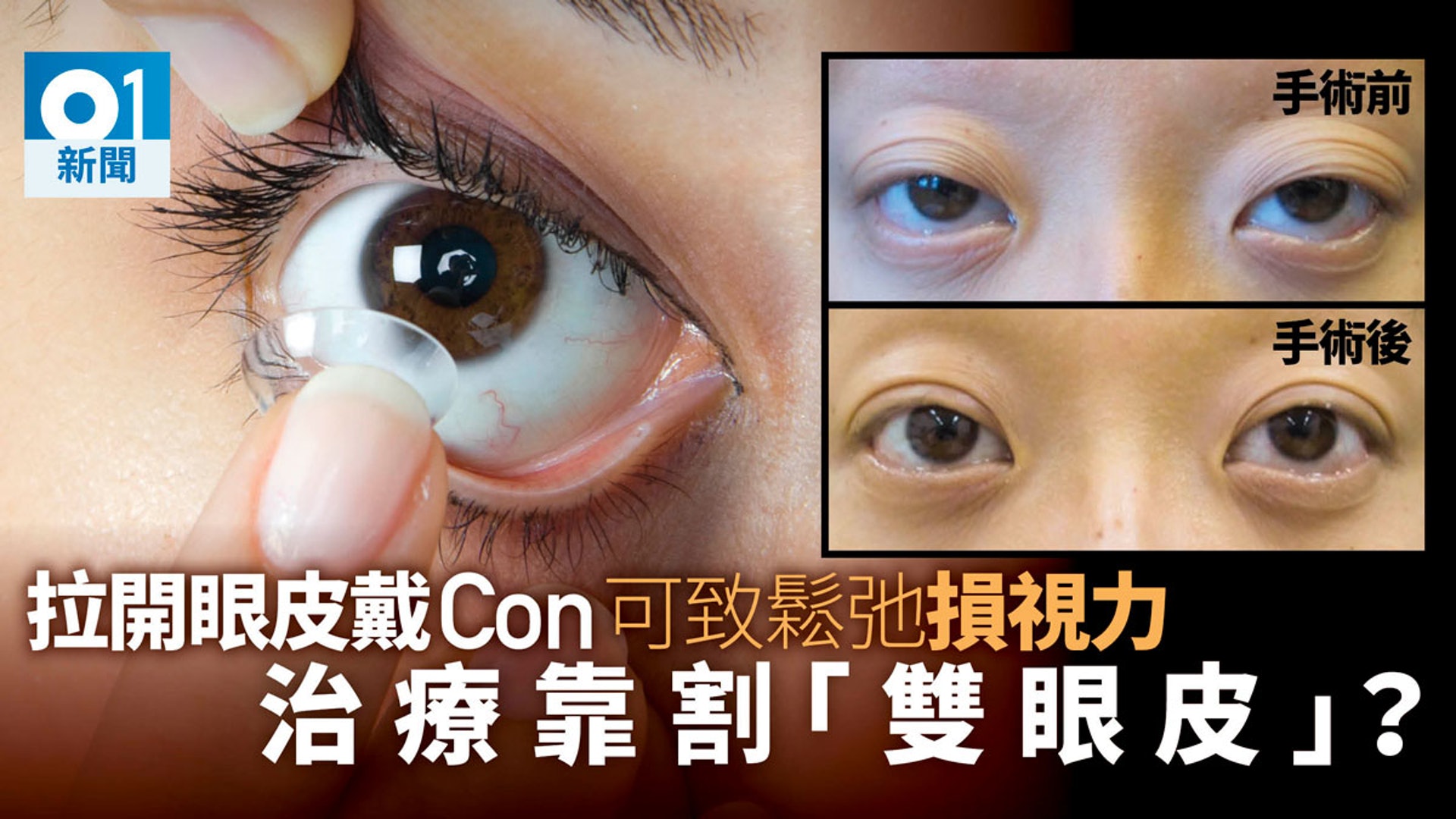 拉開眼皮戴隱形眼鏡肌肉鬆馳下垂變大細眼要做整形手術醫治 香港01 社會新聞 拉開眼皮戴隱形眼鏡肌肉鬆馳下垂變大細眼要做整形手術醫治 香港01 社會新聞