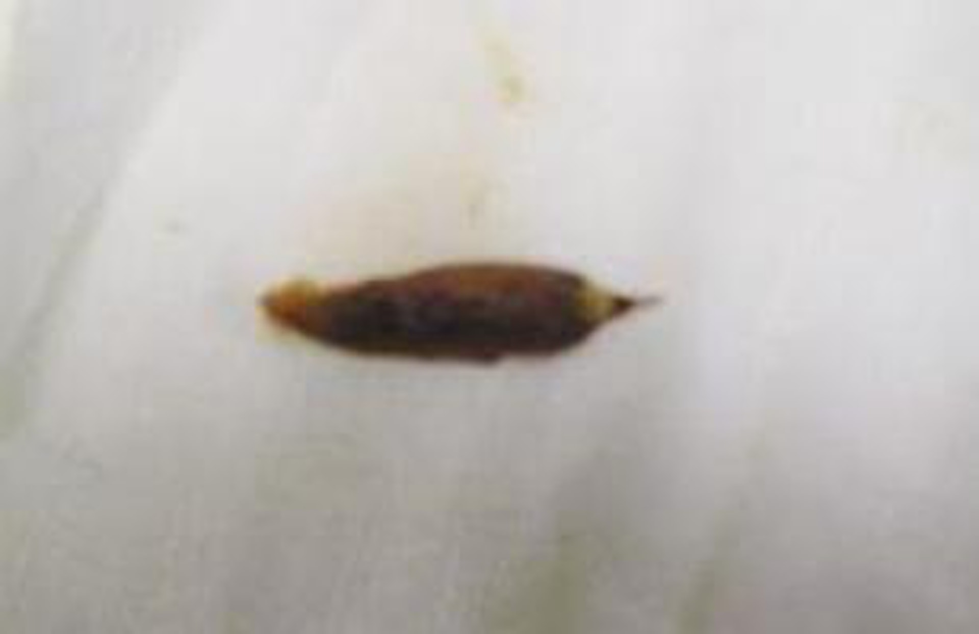 江蘇男肛門劇痛多日後求醫,棗核刺穿直腸致感染。(現代快報) 江蘇男肛門劇痛多日後求醫,棗核刺穿直腸致感染。(現代快報)