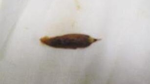 【禍從口入】江蘇男肛門劇痛多日後求醫 揭棗核刺穿直腸致感染 【禍從口入】江蘇男肛門劇痛多日後求醫 揭棗核刺穿直腸致感染