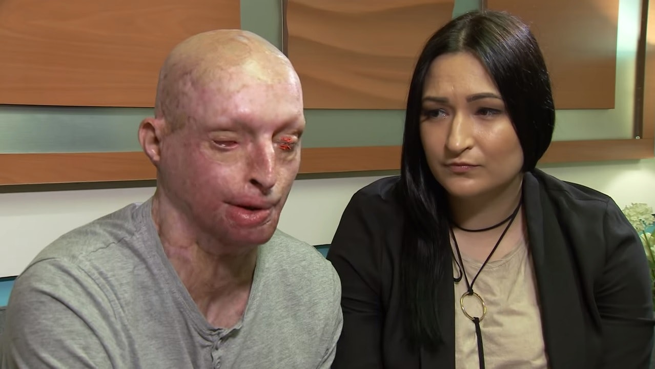 前度潑硫酸致失明毀容 未想過有人喜歡我 英漢走出陰霾成家 前度潑硫酸致失明毀容 未想過有人喜歡我 英漢走出陰霾成家