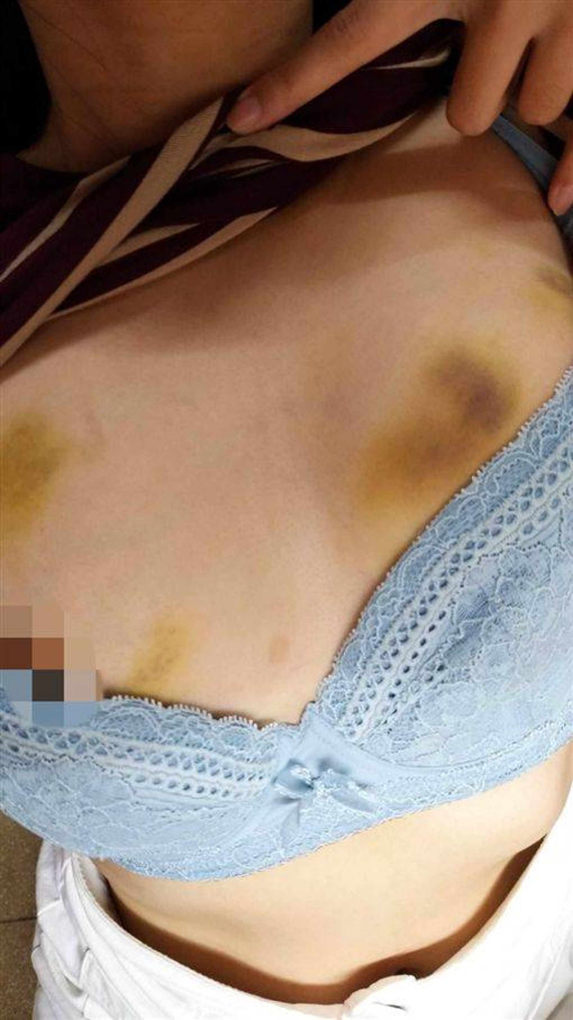 台大生謝男的前女友拍下自己被施暴的傷痕。(截取網絡) 台大生謝男的前女友拍下自己被施暴的傷痕。(截取網絡)