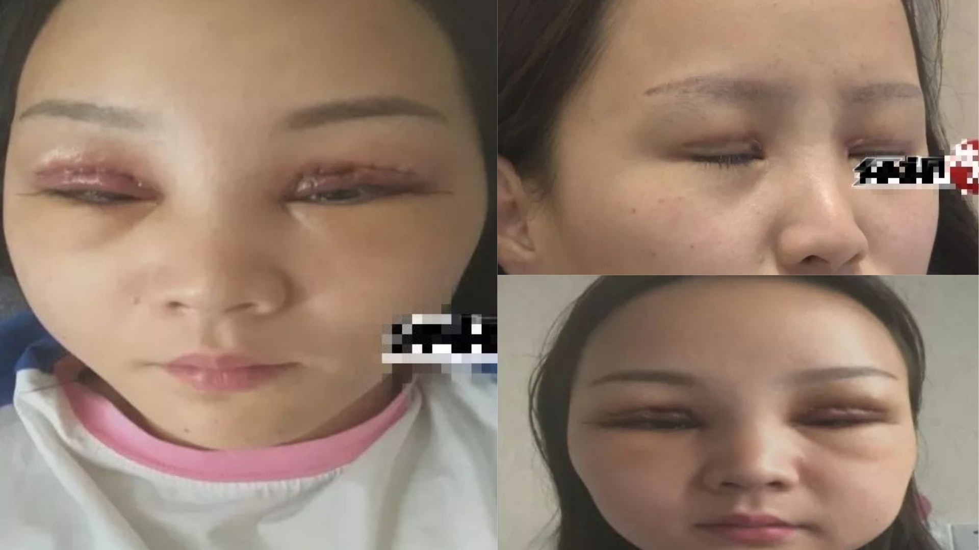 湖南女子割雙眼皮後皮膚壞死上網控訴反遭美容院索賠0萬 湖南女子割雙眼皮後皮膚壞死上網控訴反遭美容院索賠0萬