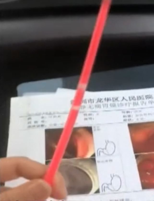 樂極生悲 深圳女子生日誤吞cm螢光棒腹痛不止需入院取出