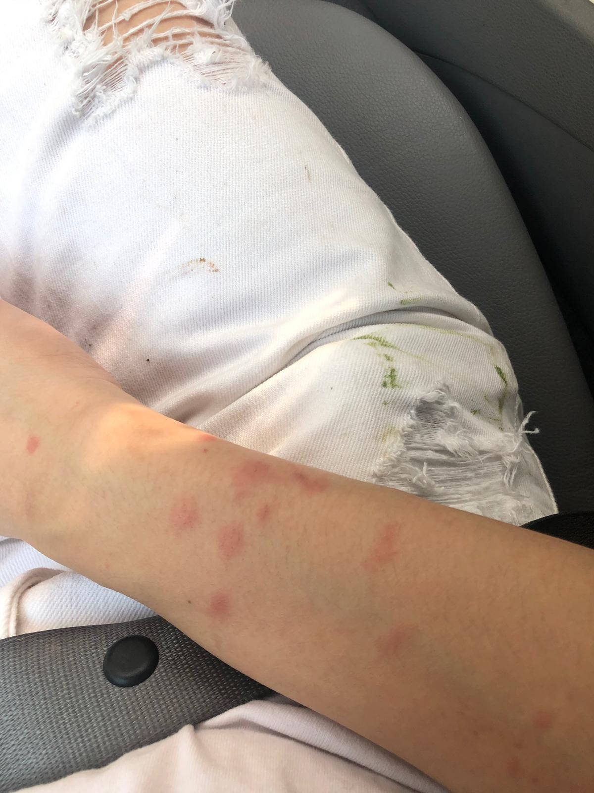 Dana手上滿佈蚊咬痕跡。(受訪者提供) Dana手上滿佈蚊咬痕跡。(受訪者提供)