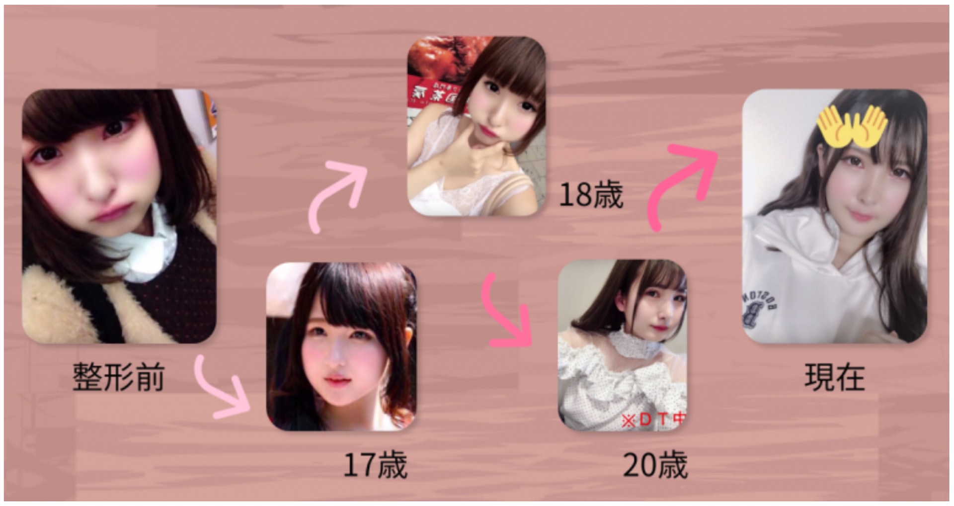 Ikiri小姐大方於網上公開自己整容歷程。(いきりちゃん)(Twitter@ikirichan) Ikiri小姐大方於網上公開自己整容歷程。(いきりちゃん)(Twitter@ikirichan)