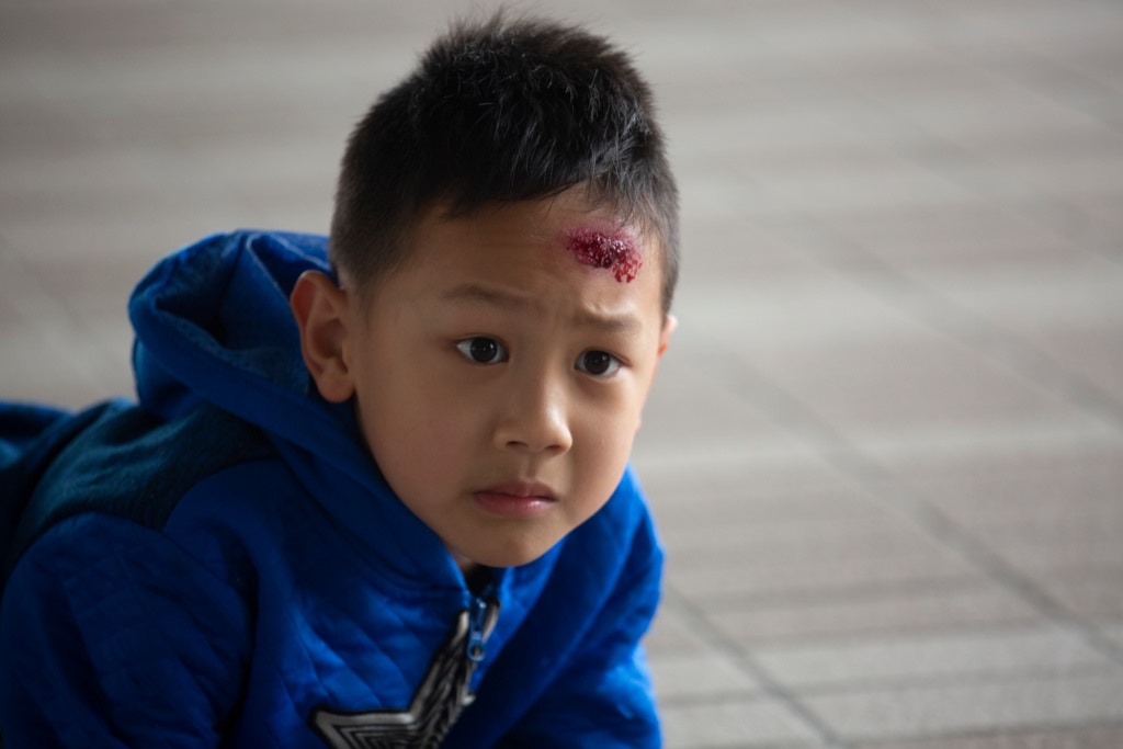 兒童急救 小孩撞傷頭部處理方法是如何 專家 家長要先冷靜 香港01 親子