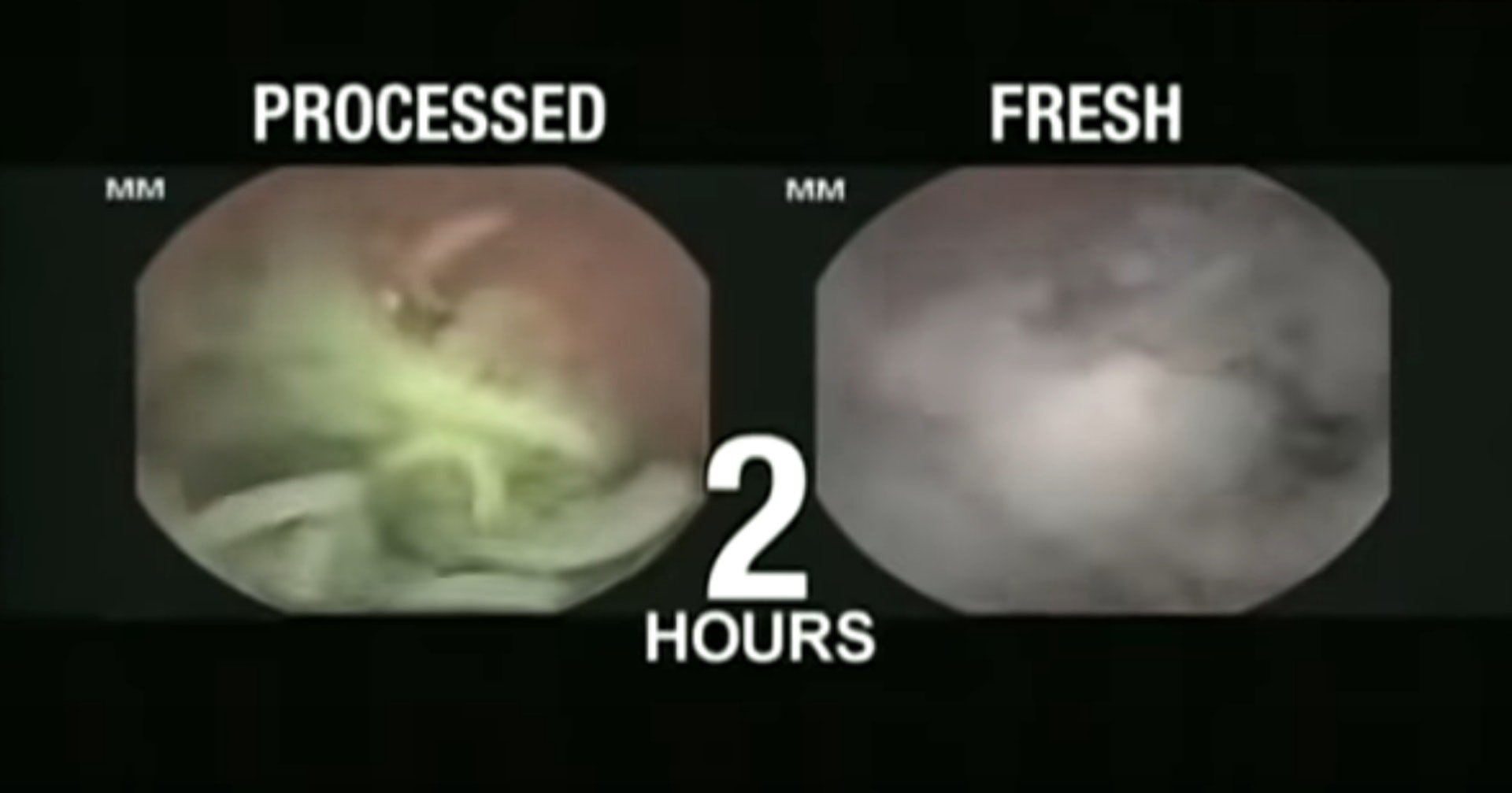 實驗中小型攝影機拍到人體胃部消化即食麵(左)以及自製拉麵(右)的情況。圖為接受測試的人已吃下麵條2小時後的情況,自製拉麵已變成糊狀物,但即食麵看來完整得多。(影片截圖) 實驗中小型攝影機拍到人體胃部消化即食麵(左)以及自製拉麵(右)的情況。圖為接受測試的人已吃下麵條2小時後的情況,自製拉麵已變成糊狀物,但即食麵看來完整得多。(影片截圖)