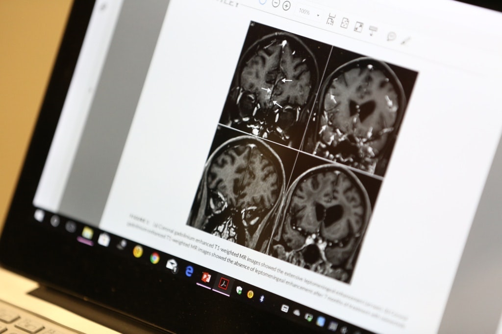 肺癌若轉移至腎上腺、肝、骨甚或腦部，幾乎無藥可治。（資料圖片）